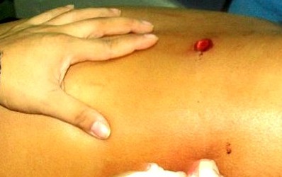 Abdominal Gunshot Wound