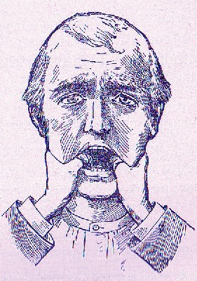 Fixing Dislocated Jaw