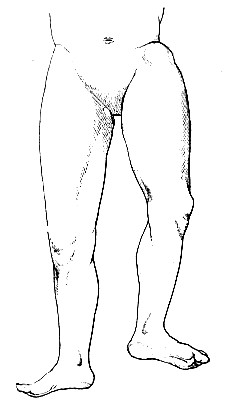 Outward Hip Dislocation