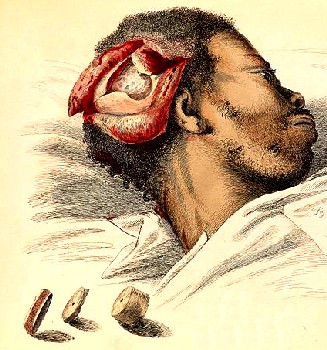 Trepanning and Bone Chips, Bell