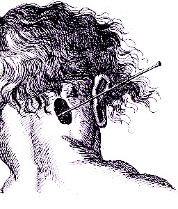 Probe in Hole in Skull