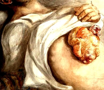 Falling Out of the Omentum