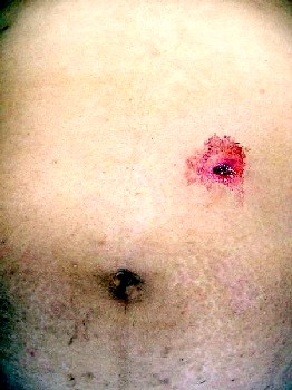 Single Gunshot Wound to Abdomen