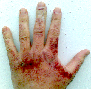 Sodium Hydroxide Burns