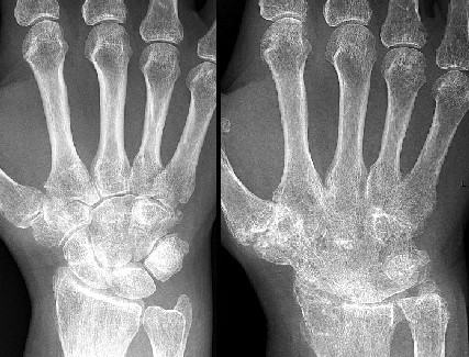 Anklyosis of the Hand