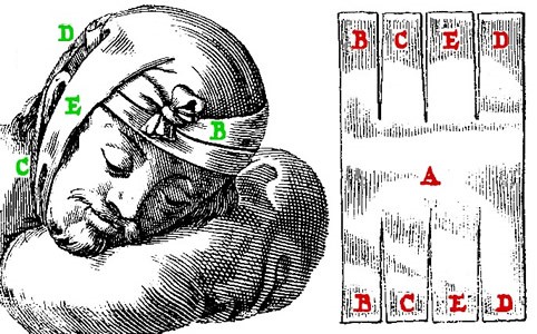 Cancer Bandage for the Head, Scultetus