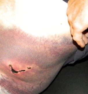 Ctonused Wound