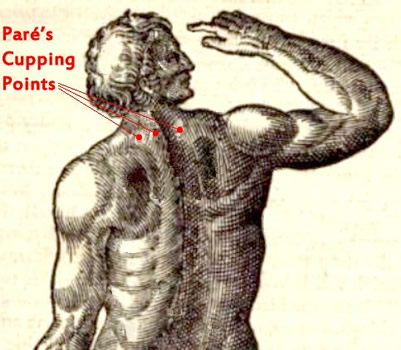 Cupping Points Specified by Pare