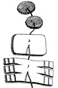 Dressings 1-3, Complex Fracture, Le Clerc