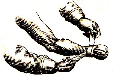 Dressings for amputation Scultetus