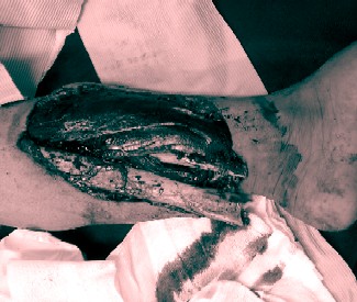 Compound Fracture of the Leg