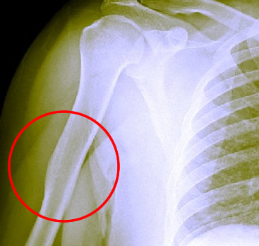 Healed Humerus Bone