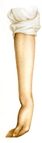 Improperly Healed Bone