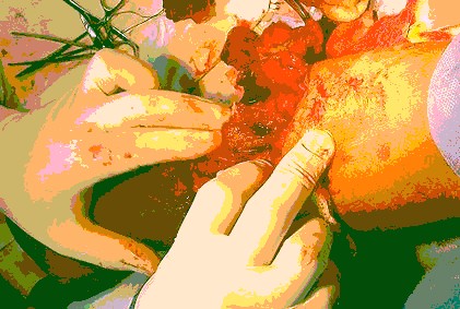 Spreading the Soft Tissue