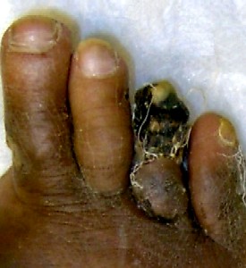 Gangrenous 4th Toe