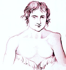 Dislocation of humerus bone