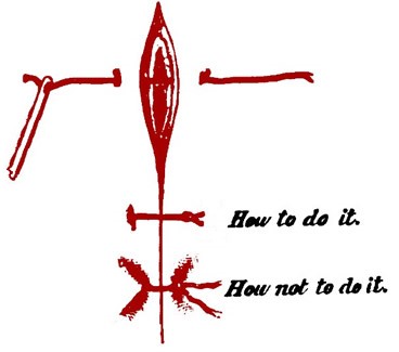 Incarnative Suture Instructions