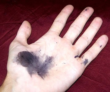 Sillver Nitrate Topical Burn