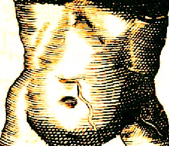 String Hanging out of Abdominal Wound