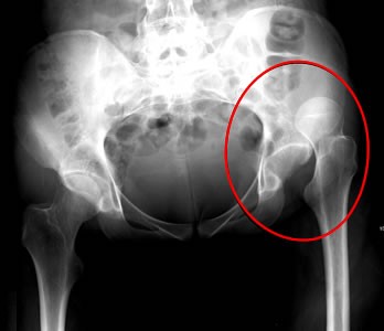 Siuperior ip Dislocation