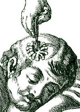 Tapered Blade on Hand Trepan, Scultetus