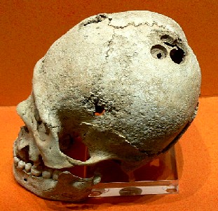 Trepanned Skull