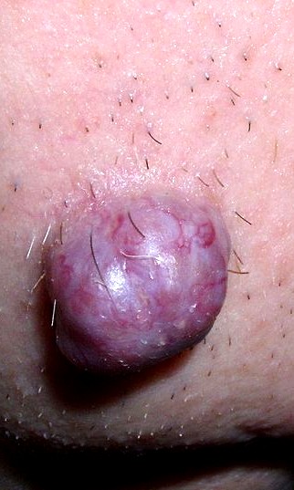 Fluid-filled tumor